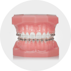 Комбинированные брекеты