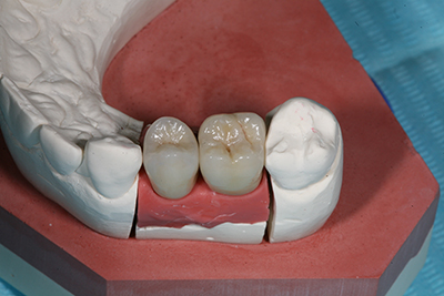 Постоянные коронки