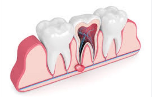 Киста зуба лечение