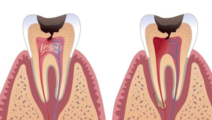 Периодонтит
