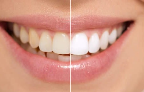 Как восстановить желтые зубы