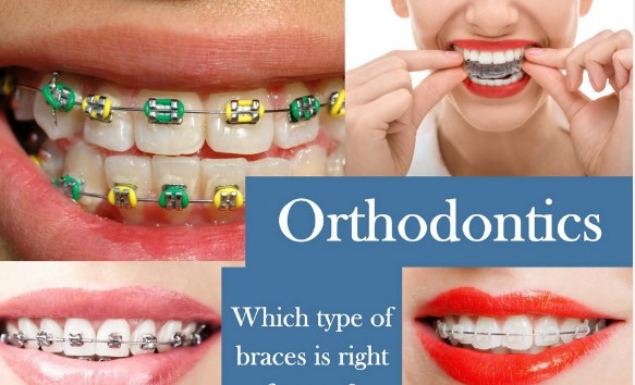 Як вирівняти зуби