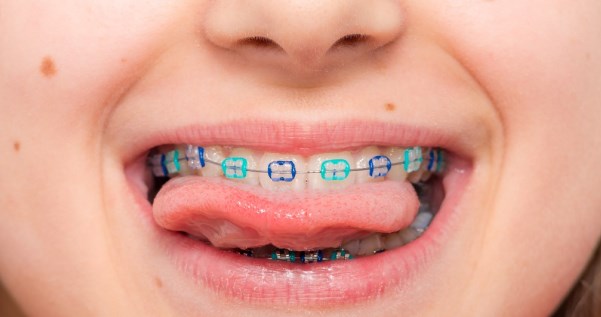 Вирівнювання зубів у дітей