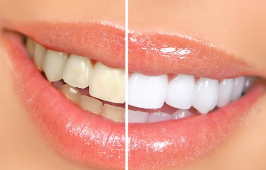 Когда нельзя отбеливать зубы