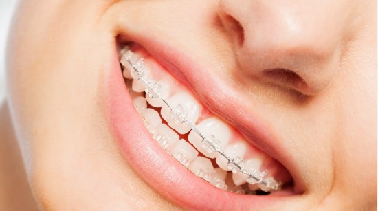 Какие брекеты лучшие для ребенка 