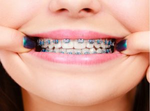 Лингвальные брекеты