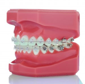 Металлические брекеты